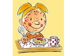 Historia de Gabriela y sus muchas alergias alimentarias